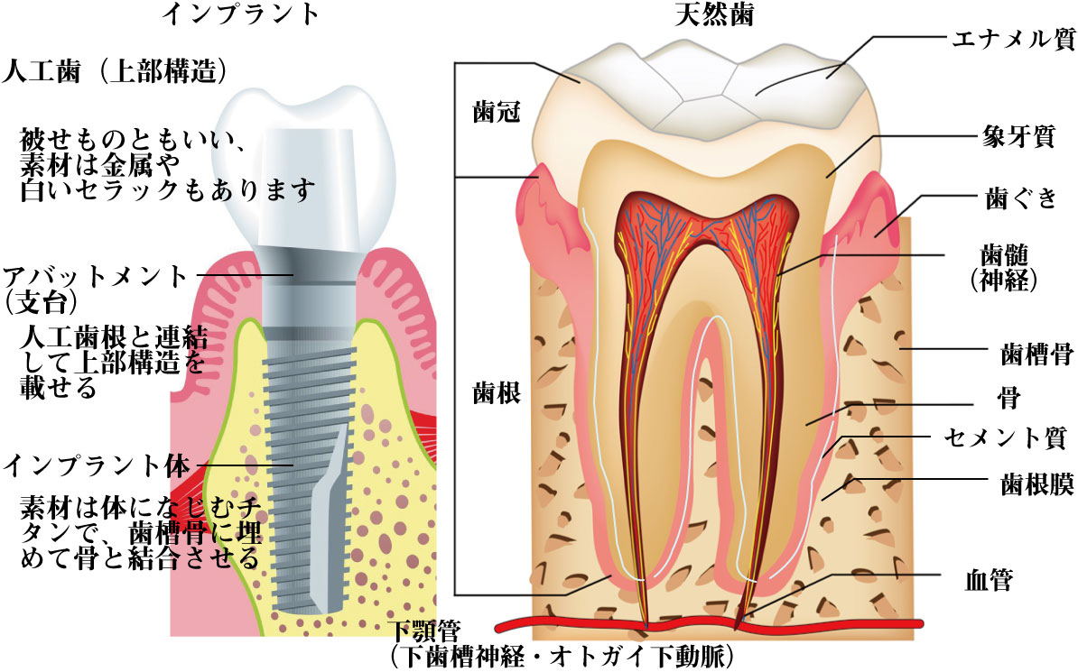 インプラント と 入れ歯 の 違い
