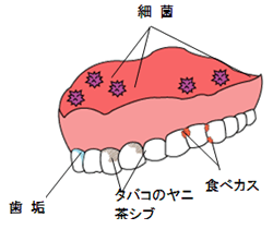 義歯の汚れの種類 総義歯の場合