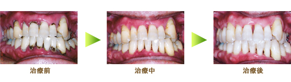 歯周病内科治療の治療例