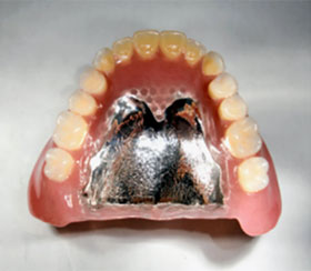 精密金属義歯